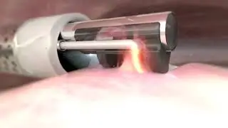 Aulea's NEW Continuous Tissue Evacuation - No more floating tissue chips
