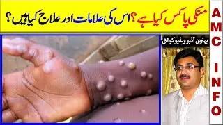 Monkeypox Virus Symptoms, Causes & Treatment In Urdu  | Mpox  | منکی پاکس | AMC info