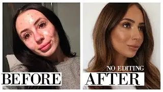 THE ONLY PRODUCTS THAT HAVE EVER CLEARED MY ACNE