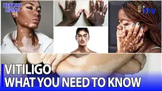 Understanding Vitiligo | HEALTHY LIVING