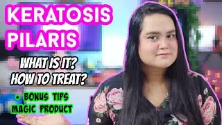 KERATOSIS PILARIS / KP | WHAT? WHY? TREATMENT & TIPS | MAGIC CURE? | MAITRAYEE HALDER