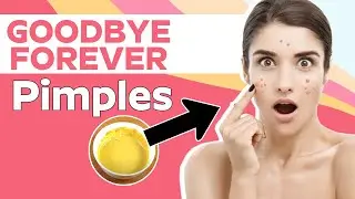 How To Make Your Acne Disappear Overnight |  Home Remedies For Pimples | Beauty Tips | Orange Health