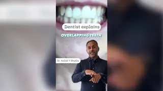 How to straighten overlapping teeth 🦷 #shorts