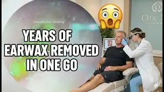 Years-Old Ear Wax Finally Cleared ASMR