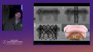 TMVR and LV Apex Closure