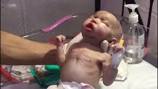 Chest physiotherapy for pneumonia baby