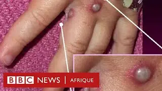 Tout savoir sur la variole du singe en moins 5 minutes gr&acirc;ce &agrave; cette vid&eacute;o