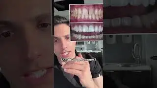 Should you get veneers