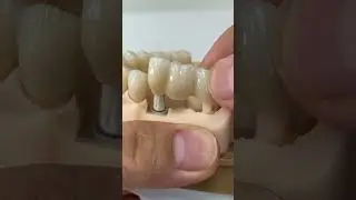 Between cement and screw retained implants!