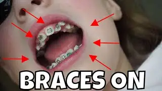 EMILY GETS HER BRACES ON | STOWED STUFF