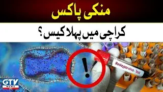 Health News | First case of Monkeypox in Karachi? | Monkeypox Virus | Breaking News