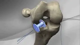 ACL RECONSTRUCTION   SURGICAL TECHNIQUE ALL INSIDE ACL RETRO CONSTRUCTION