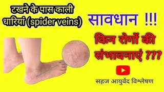 Ankle joint and spider veins। @Dr.RajeshKanwaria #ayurveda #clinical #information  #educational