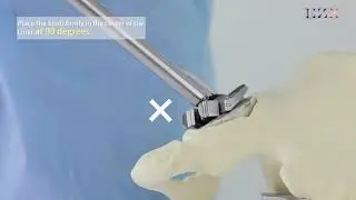 [IMEDICOM's product] EZX Acetabular cup removal system - How to use