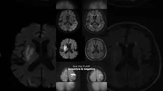 Wake Up Trail: Would you give thrombolytics beyond 4.5 hours in Ischemic #stroke?