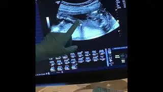 Baby's First Kicks Caught on Camera | 18 Weeks Pregnancy #shorts
