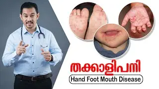 തക്കാളിപ്പനി | Tomato Fever | Hand Mouth Foot Disease (HFMD) | അറിയേണ്ടതെല്ലാം | Dr Arun K V
