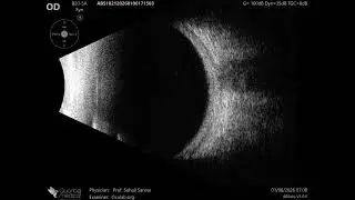 20 MHz Annular Ophthalmic Ultrasound ABSolu, Normal ocular and orbital ultrasonography , 36905