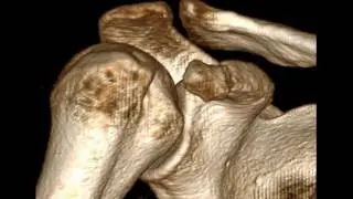 Scapula Coraoid process Fracture