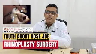 ENT Surgeon explains NOSE JOB aka RHINOPLASTY | Wellsun Medicity Hospital
