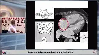Training Village Trans-Septal Puncture or PTMC