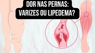 DOR NAS PERNAS: VARIZES OU LIPEDEMA?