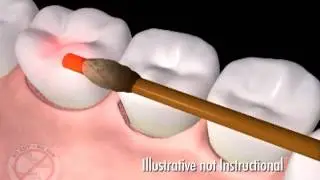 Poway CA Cosmetic Dentist Provides Patient Education - Lanap Video of Periodontal Disease Treatment