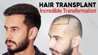 Best Hair Transplant in India Cost | Best Clinic | Medispa Hair Transplant in India | Dr Suneet Soni