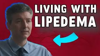 Dr. Alexandre Amato: Is it possible to live with Lipedema? Have quality of life?