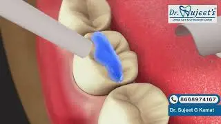 Dental Sealants Explained | How Sealants Protect Teeth from Cavities | Dr. Sujeet Dental Care#shorts