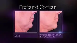 Syneron Candela: Profound Teaser