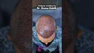 Chinese method hair transplant performed by Dr. Huma Habib with precision and care.💯🌟.