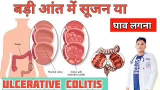 आंत में सूजन या घाव होना | Ulcerative ulcer | ulcerative colitis symptoms, #ulcerativecolitis