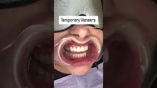 Veneers: First Step to Your Perfect Smile! | Kansas City Dentist #veneers #cosmeticdentistry
