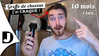 [10 mois post-greffe] Je me rase le crâne ENTIÈREMENT ! 😱