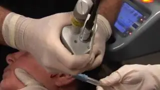 DOT Therapy Skin Resurfacing, Las Vegas