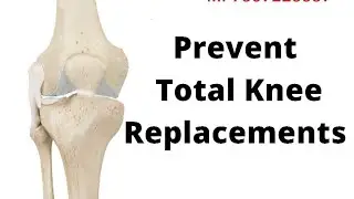 Prevent Total Knee Replacements. Safe Natural Joints.Doctor Bulao. Dr Madhur Thawani