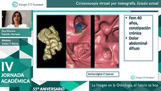 Colonoscopia virtual por tomografía. Estado actual