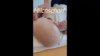 Milchschorf bei Babys entfernen