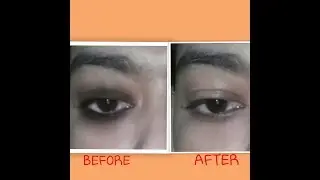 How To Remove Dark Circles Naturally||Home Remedies Remove Eye Dark Circles in 3 Ways||