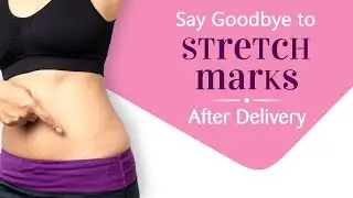 Say Goodbye to Pregnancy Stretch Marks: Effective Tips & Tricks!