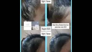 ATOMY HAIR TONIC RESULTS