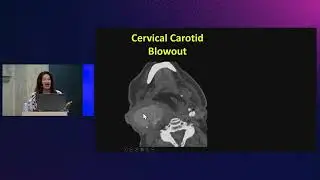 Soft tissue is an issue: prevertebral invasion and carotid blowout | Prof. Laurie A. Loevner