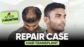 Hair Transplant in Lucknow | Best Results & Cost of Hair Transplant in Lucknow