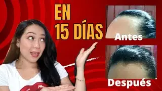 Qu&eacute; es mejor el Minoxidil o el Capixyl ~ Mi Experiencia//C&oacute;mo detener la Ca&iacute;da del Cabello?