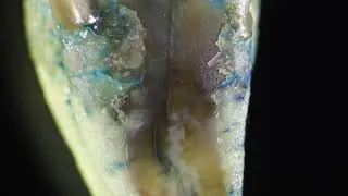 Evaluation of suspected vertical root fracture
