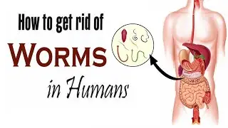 How to Get Rid of Worms in Humans Naturally || Home Remedies for Intestinal Parasites in Human