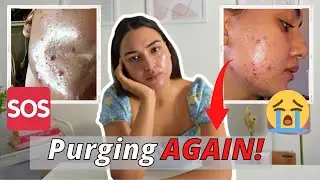 JUST GET OVER IT?! | TRETINOIN CREAM 0.05% FOR ACNE AND ACNE SCARS CHAT - SELF ESTEEM IMPACT.