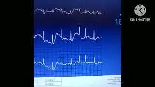 Épreuve D'effort : Evaluation de la Capacité Fonctionnelle