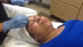 Chemical Peel Experience!